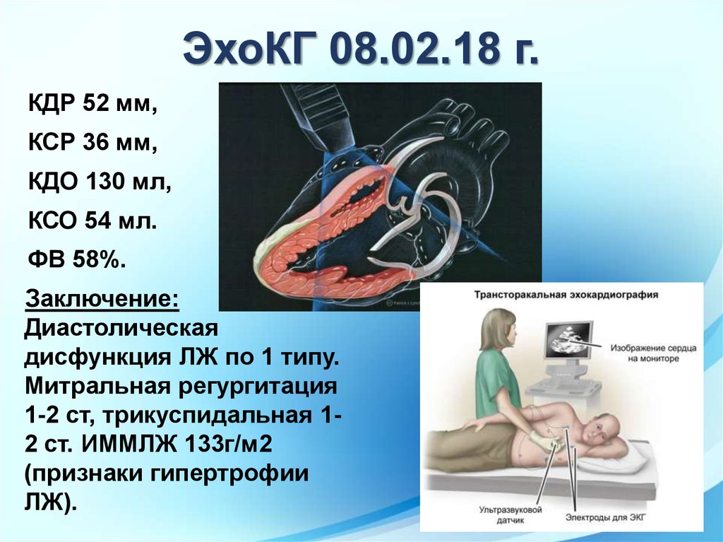 Эхо вызванное. ЭХОКГ расшифровка. КДР ЭХОКГ. Интерпретация ЭХОКГ. ЭХОКГ аббревиатуры.