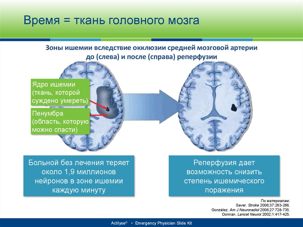 Ишемия головного мозга стадии. Зоны ишемии головного мозга. Ядро ишемии зона Пенумбра. Зона Пенумбры при инсульте. Реперфузия мозга.