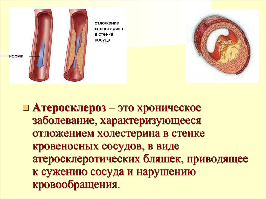 Атеросклероз и стенокардия