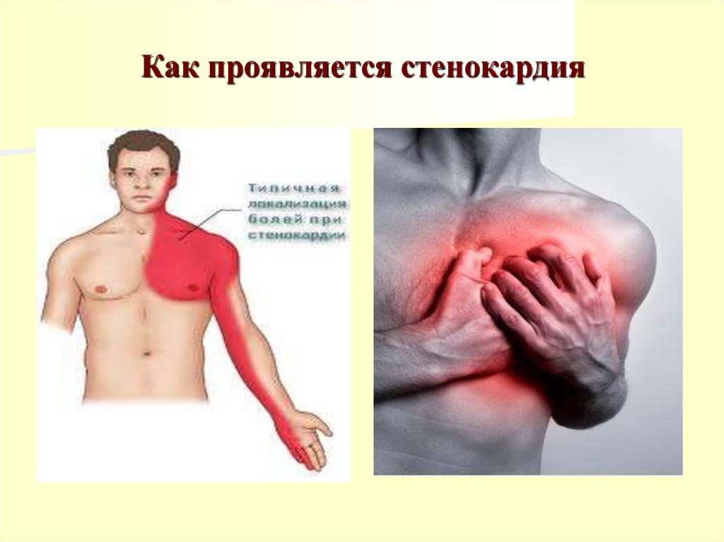 Как проявляется стенокардия