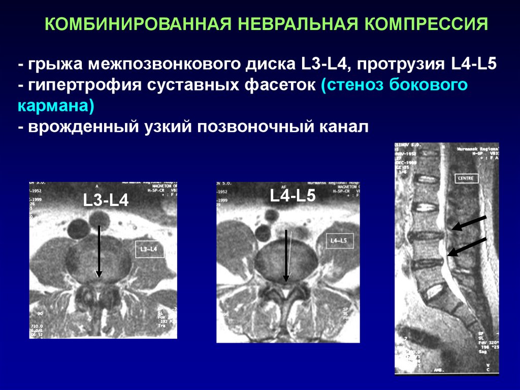 Абсолютный стеноз. Латеральный карман позвоночника. Латеральный карман позвоночного канала. Стеноз позвоночного канала на кт. Врождённый узкий Позвоночный канал.