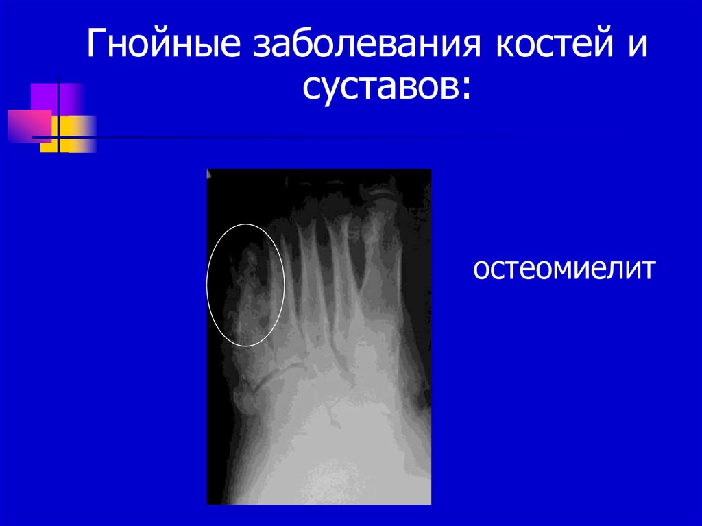 Презентация гнойные заболевания костей и суставов