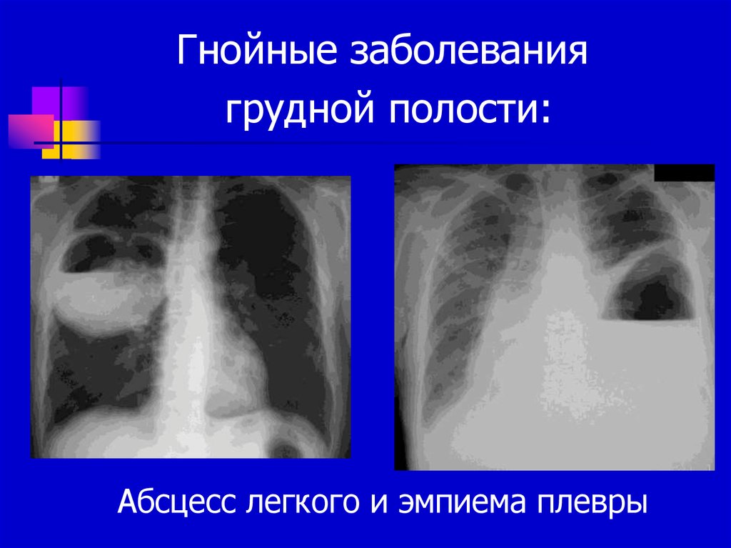 Гнойные абсцессы легких. Патология плевральной полости. Нагноительные заболевания легких абсцесс. Нагноительные заболевания легких и плевры. Гнойные заболевания легких.