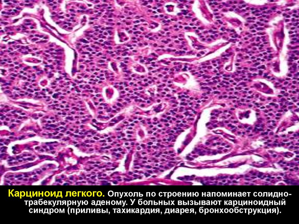 Карциноид. Карциноид легкого гистология. Карциноид кишечника гистология. Карциноидная опухоль желудка гистология. Атипичный карциноид легкого.