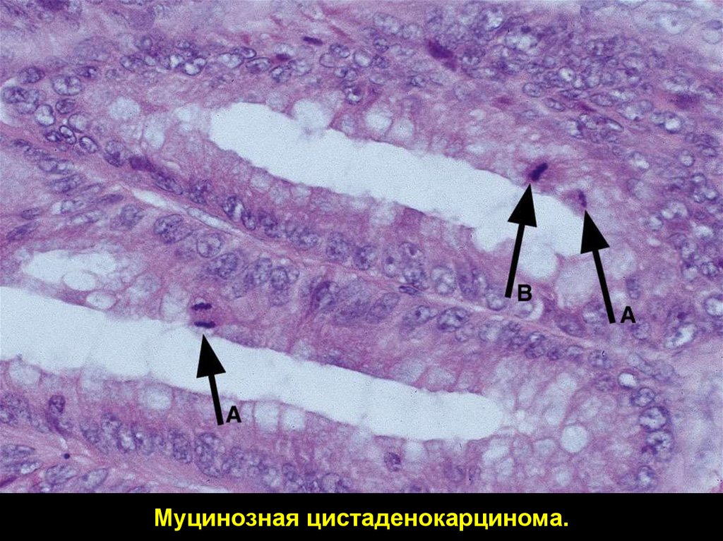 Муцинозные опухоли яичников