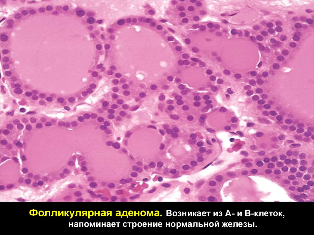 Фолликулярный щитовидной железы. Микрофолликулярная аденома щитовидной гистология. Фолликулярная аденома щитовидной железы цитология. Фолликулярная аденома гистология. Аденома щитовидной железы гистология.