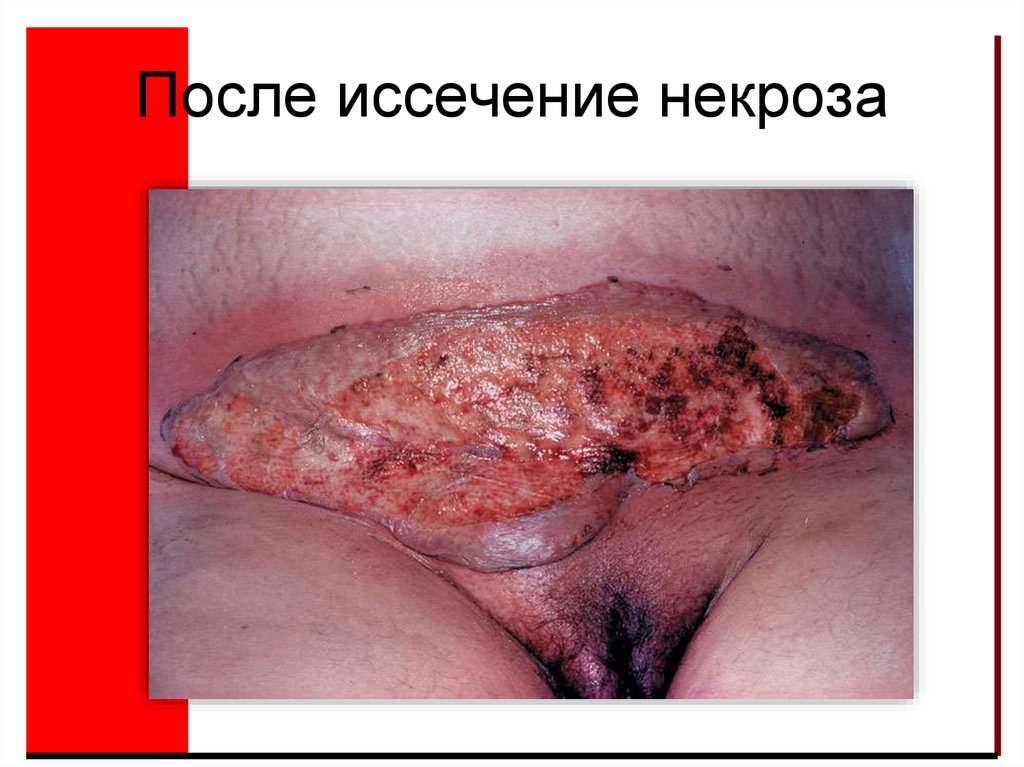 После иссечение некроза