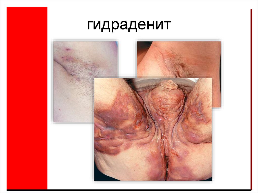 гидраденит