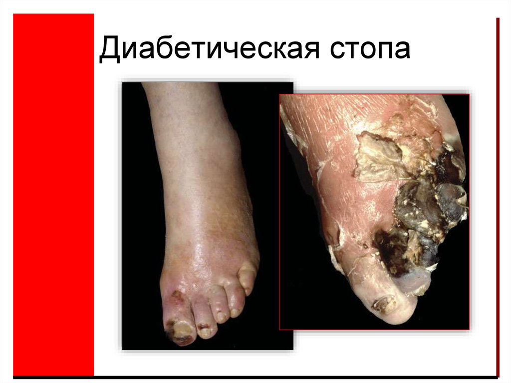 Диабетическая стопа