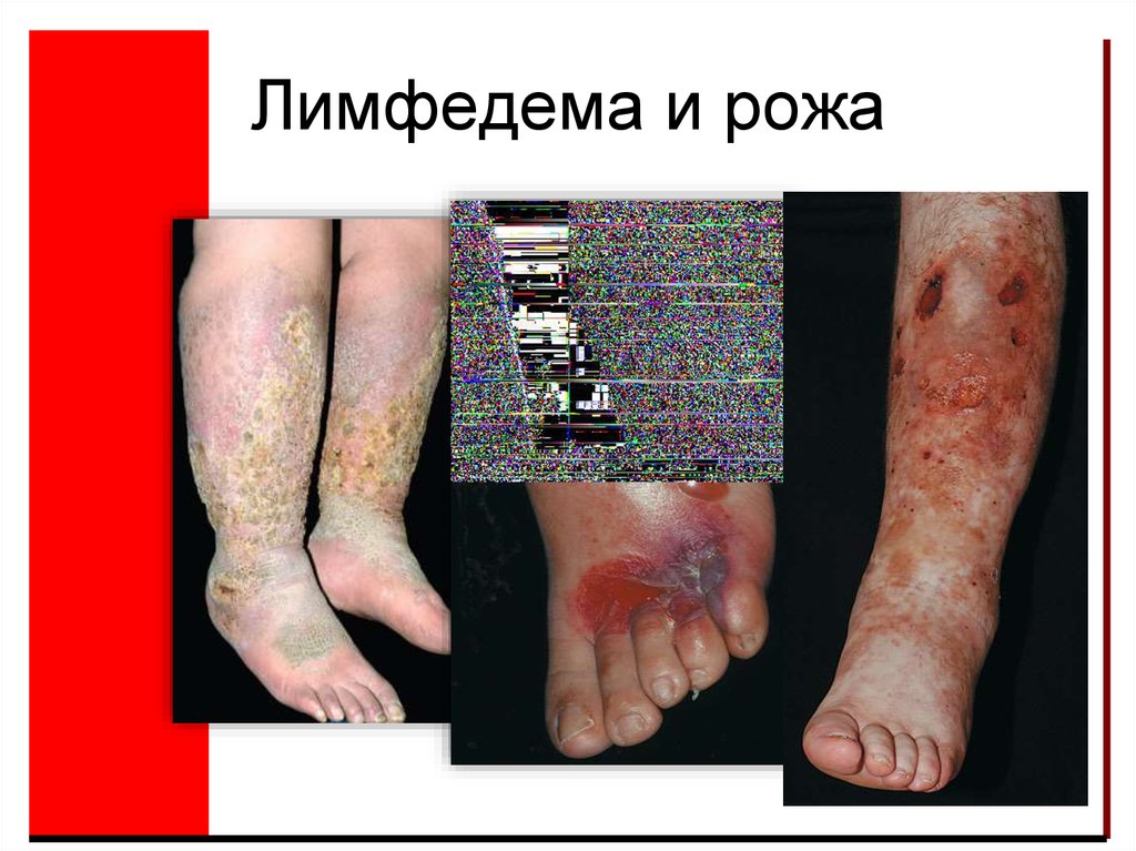 Лимфедема и рожа