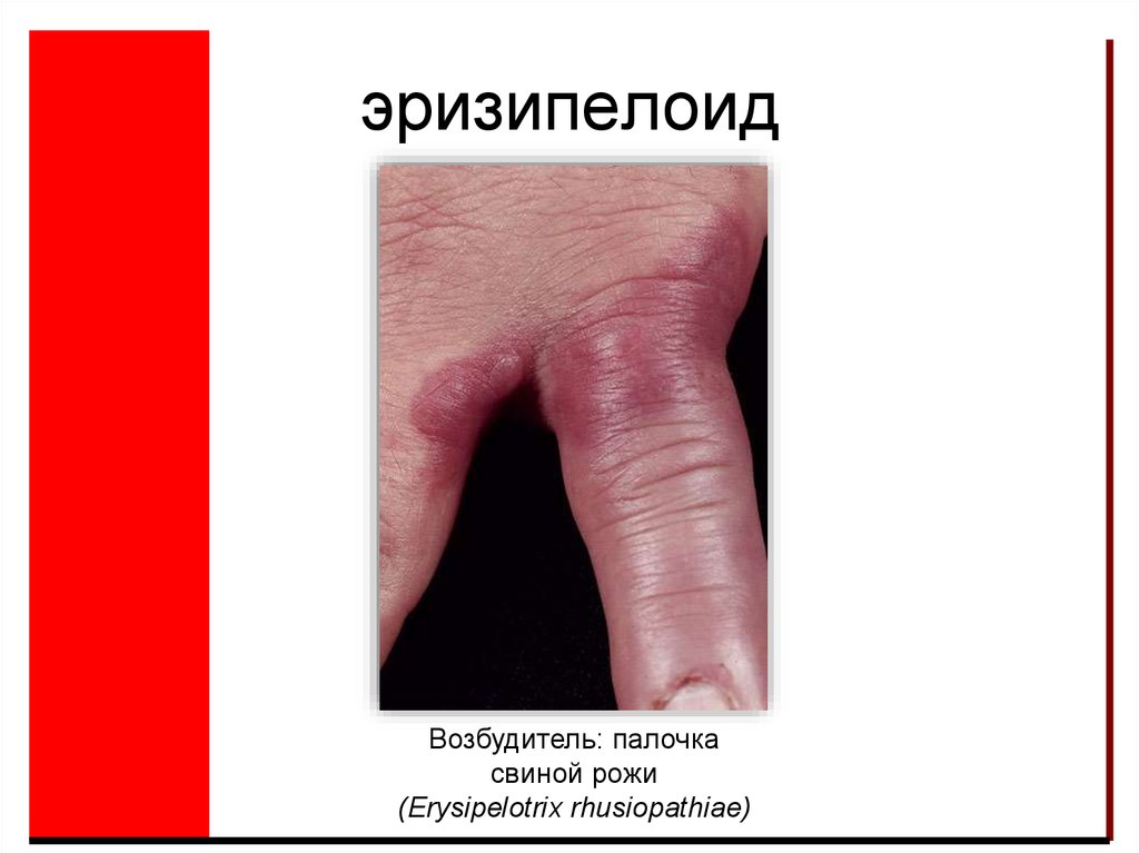 эризипелоид