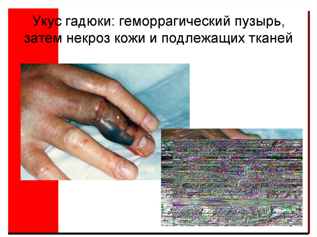 Укус гадюки: геморрагический пузырь, затем некроз кожи и подлежащих тканей