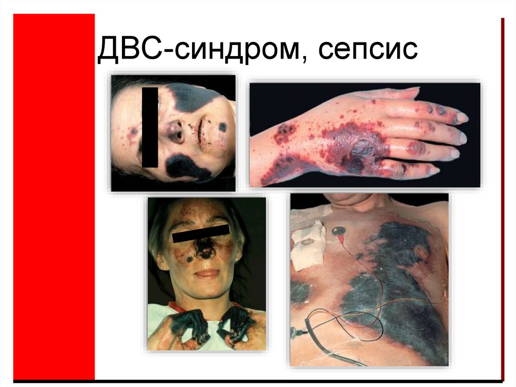 ДВС-синдром, сепсис