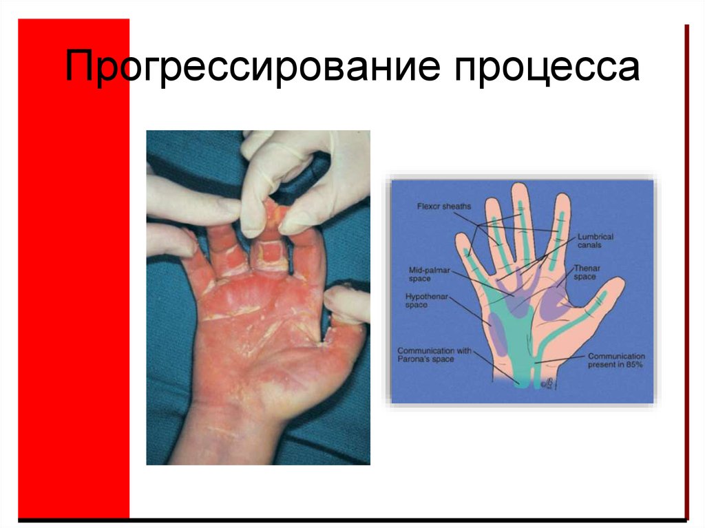 Прогрессирование процесса