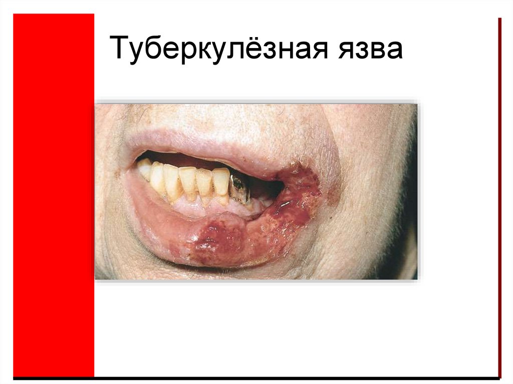 Туберкулёзная язва