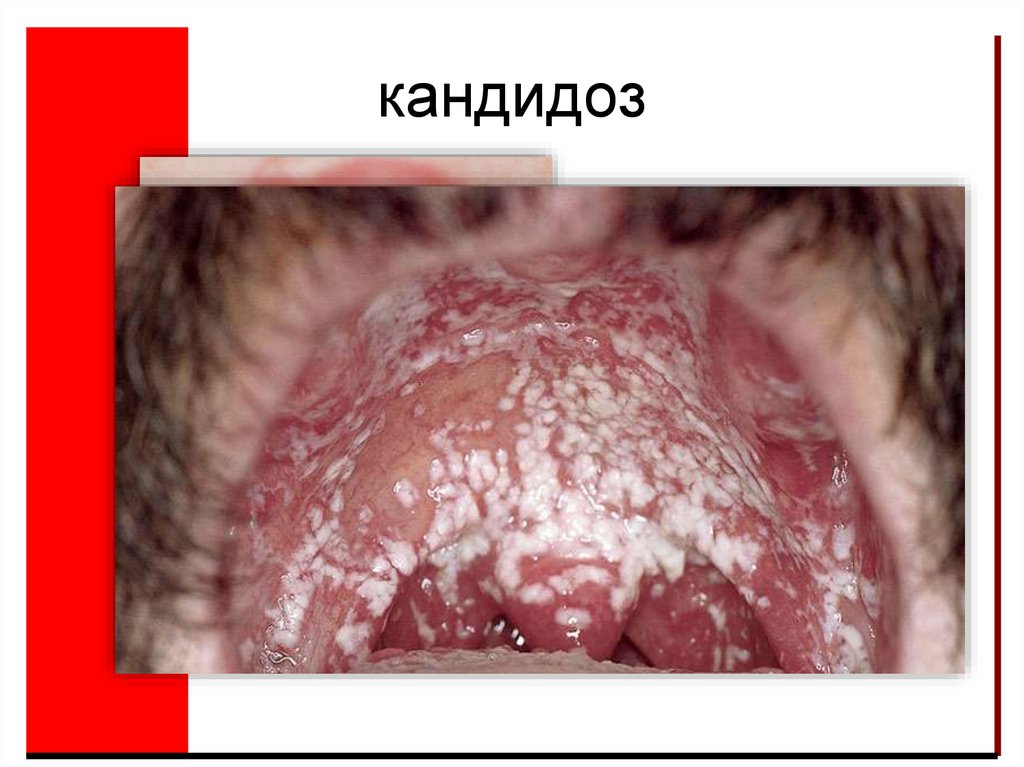 кандидоз