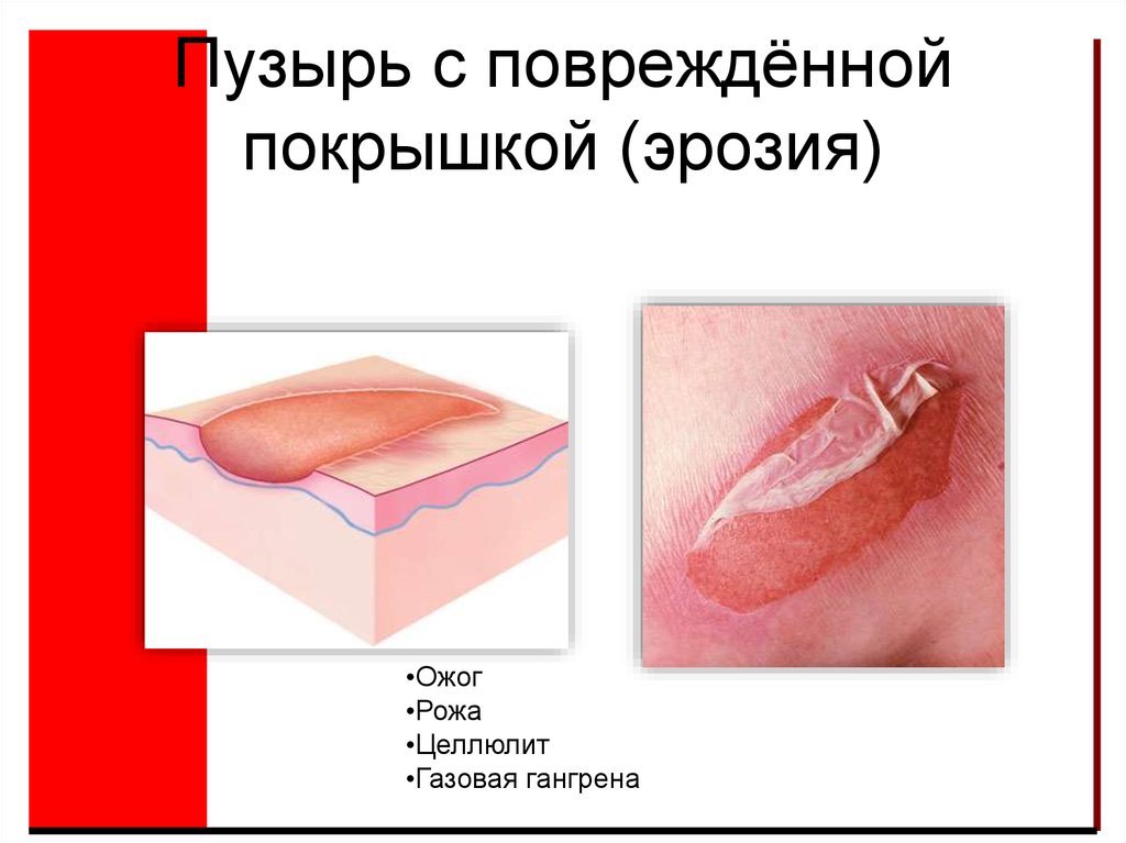 Пузырь с повреждённой покрышкой (эрозия)