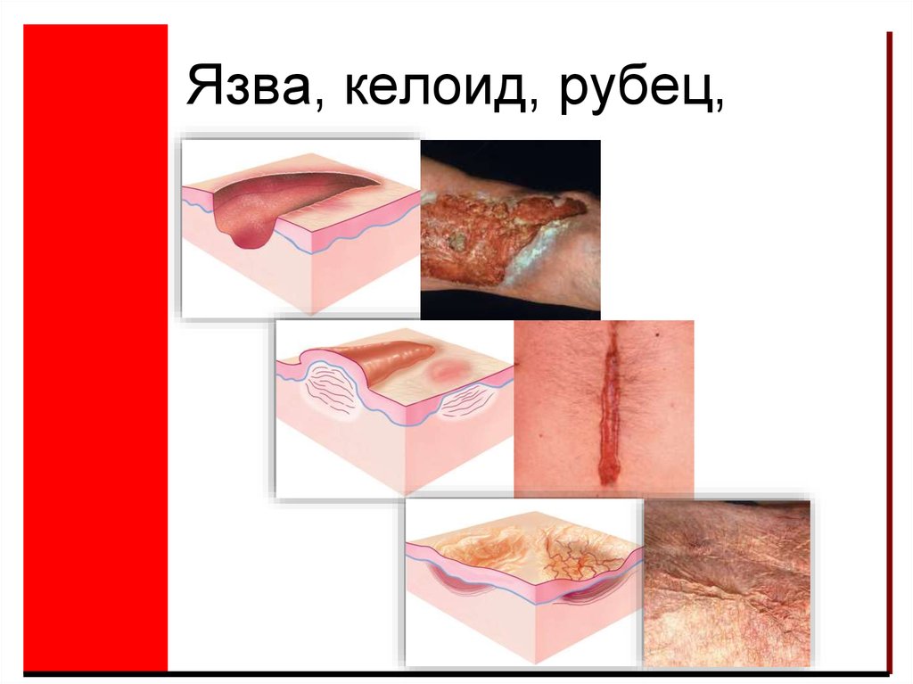 Язва, келоид, рубец,