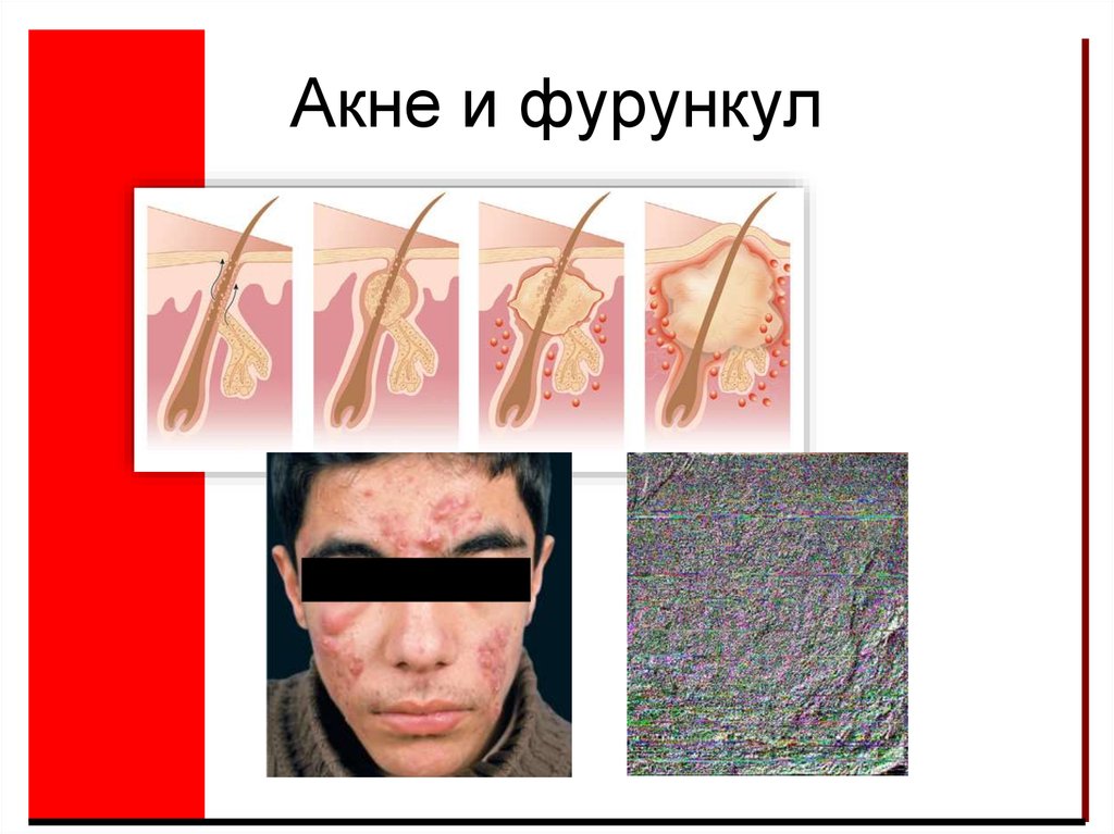 Акне и фурункул