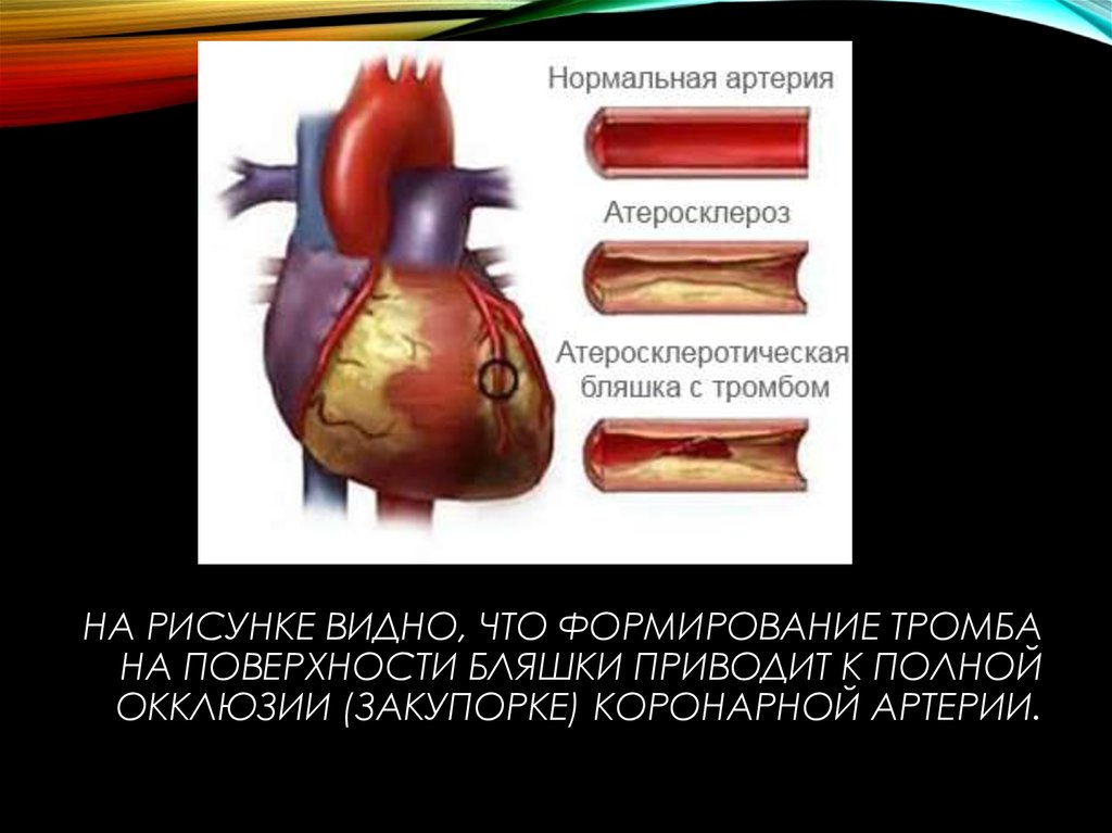 Коронарная окклюзия. Закупорка коронарной артерии. Бляшки в коронарных артериях. Тромб в коронарной артерии. Разрыв коронарного сосуда.