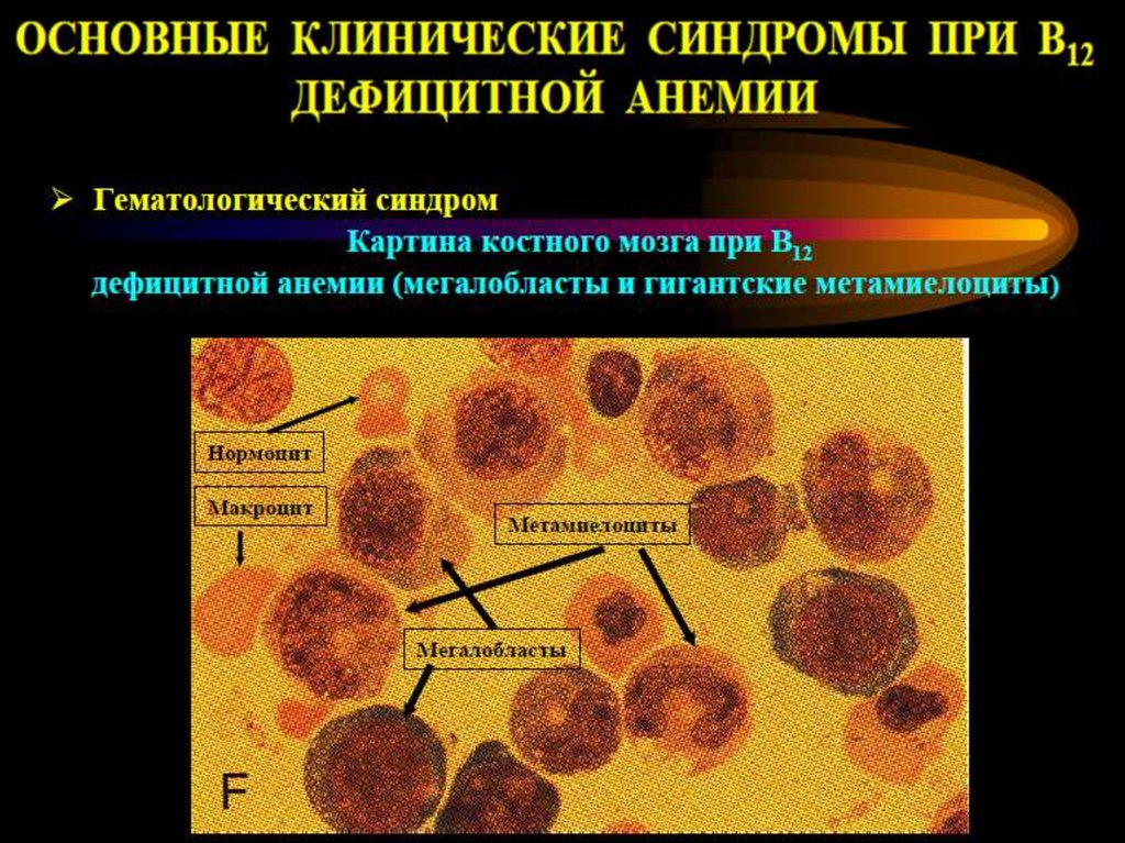 Анемия стул. Б12 дефицитная анемия. Кожные покровы при в12-дефицитной анемии. Б12 дефицитная анемия картина крови. Цвет кожных покровов при в12-дефицитной анемии.