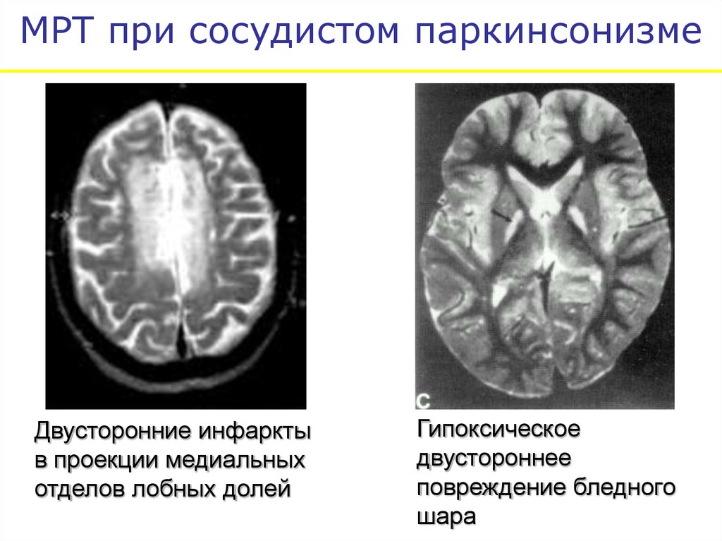 Деменция при паркинсоне. Болезнь Паркинсона на мрт головного мозга. Болезнь Паркинсона мрт признаки. Кт головного мозга при паркинсоне. Болезнь Паркинсона мрт картина.