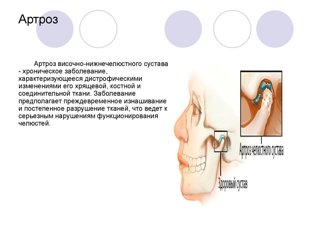 Болит сустав возле уха. Артроз ВНЧС степени 1 рентген. Аксиографическое исследование ВНЧС. Деформирующий артрит ВНЧС.