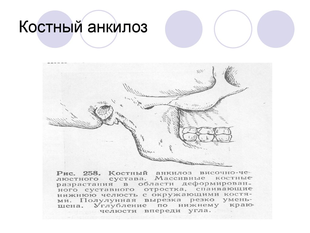 Анкилоз челюсти. Анкилоз ВНЧС этиология. Анкилоз височно-нижнечелюстного сустава. Анкилоз ВНЧС патогенез.