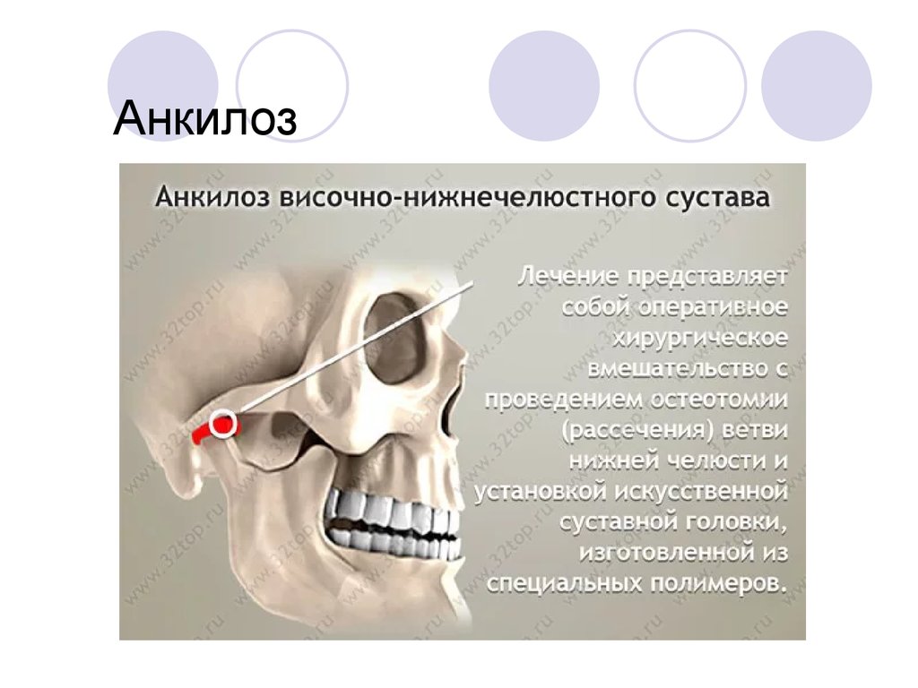 Презентация на тему анкилоз внчс