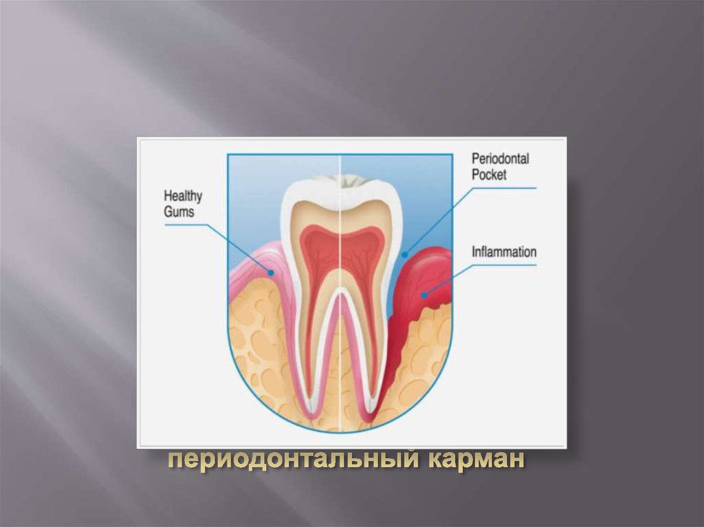 Образование периодонтальный карман
