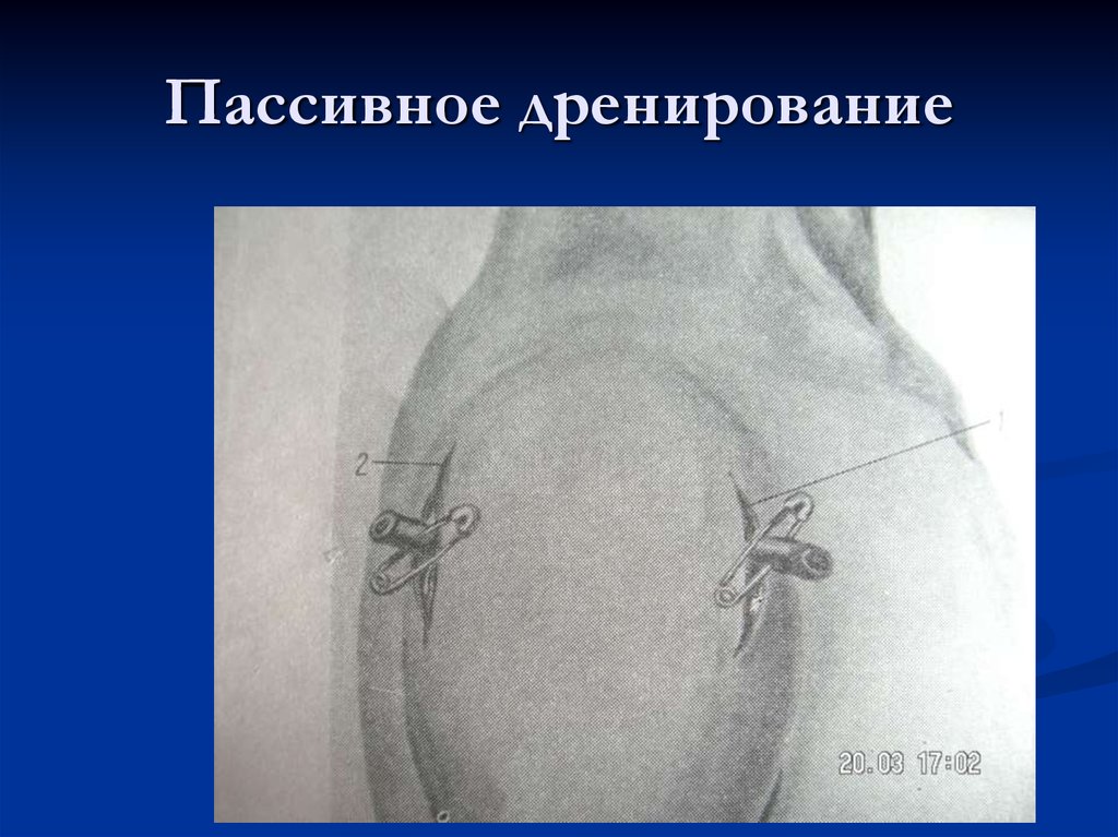 Дренирование. Пассивное дренирование. Виды пассивного дренирования. Дренирование полостей пассивной.