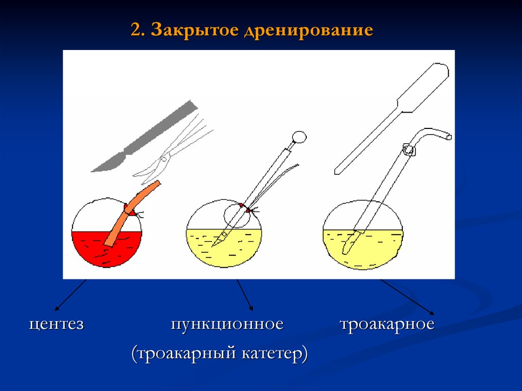 Физическая антисептика дренирование. Закрытое дренирование. Физическая антисептика картинки.