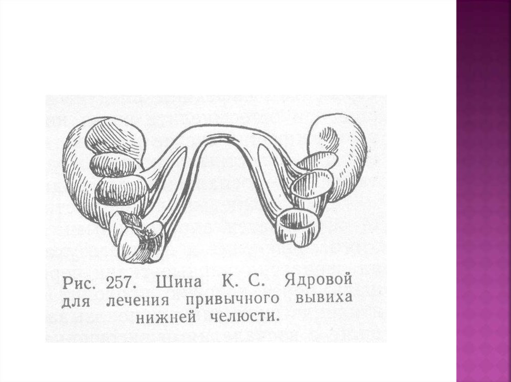 Привычный вывих нижней челюсти карта вызова