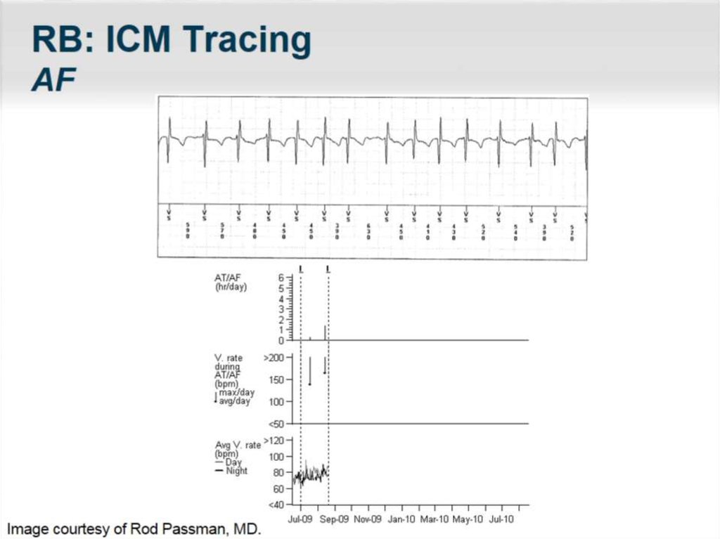 RB: ICM Tracing AF