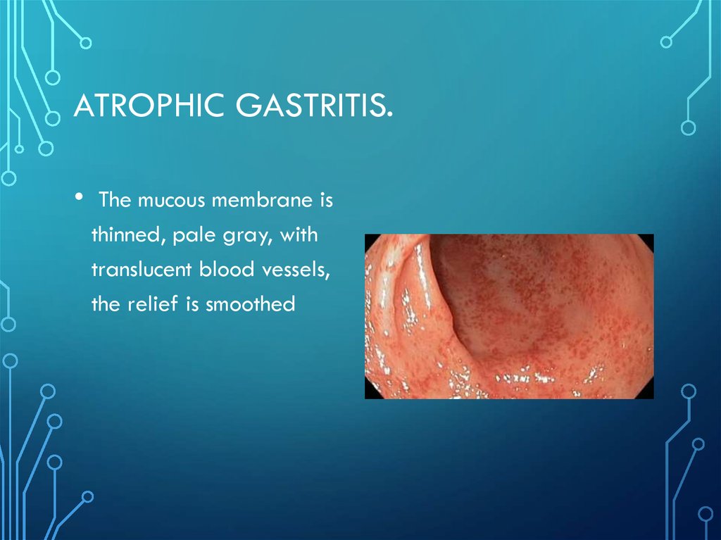 Chronic Gastritis Online Presentation 