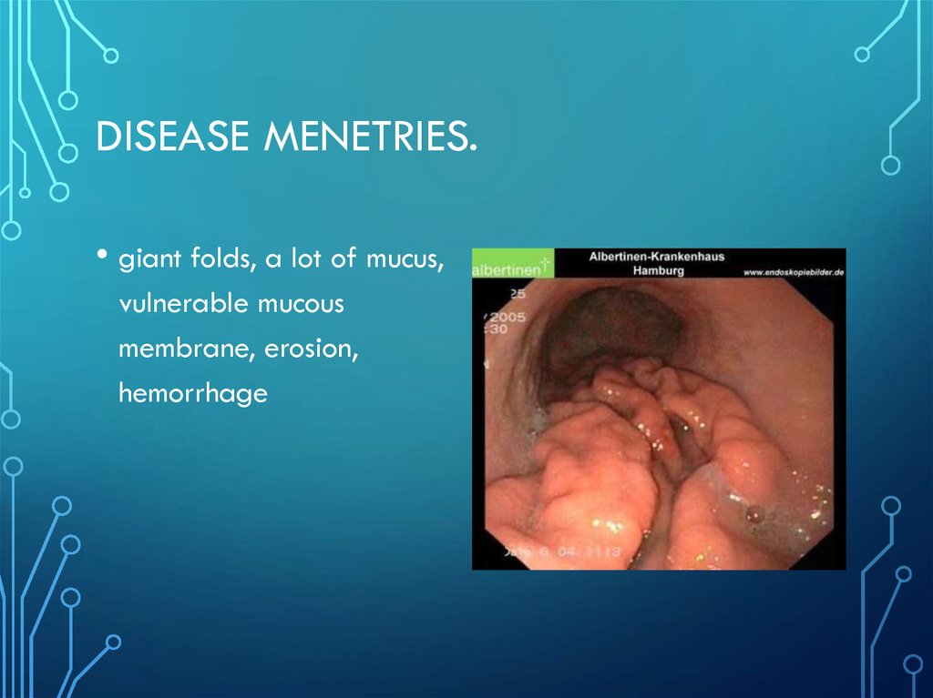 Disease Menetries.