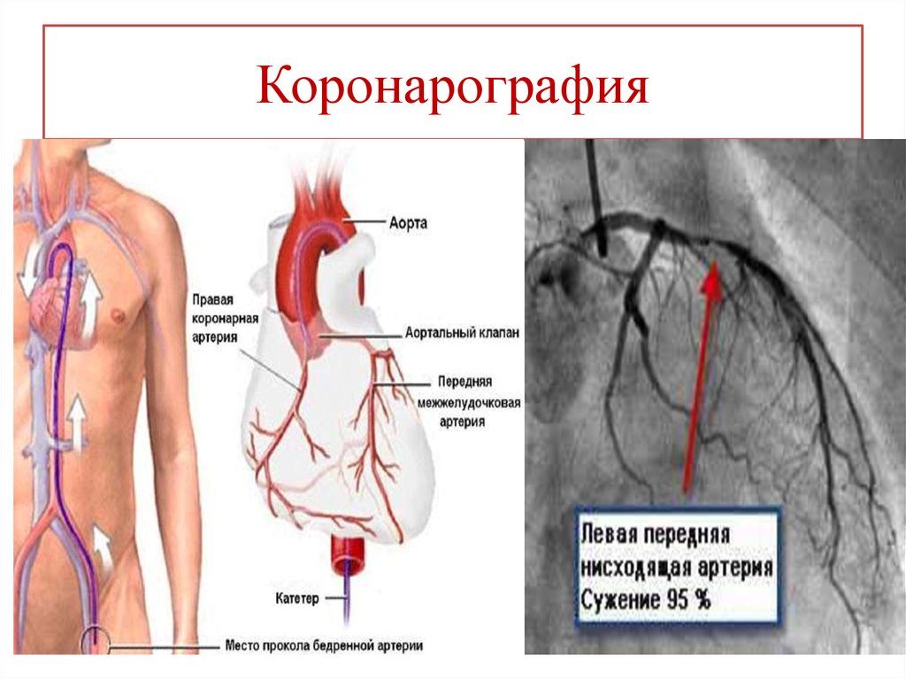 Коронарография сердца через руку