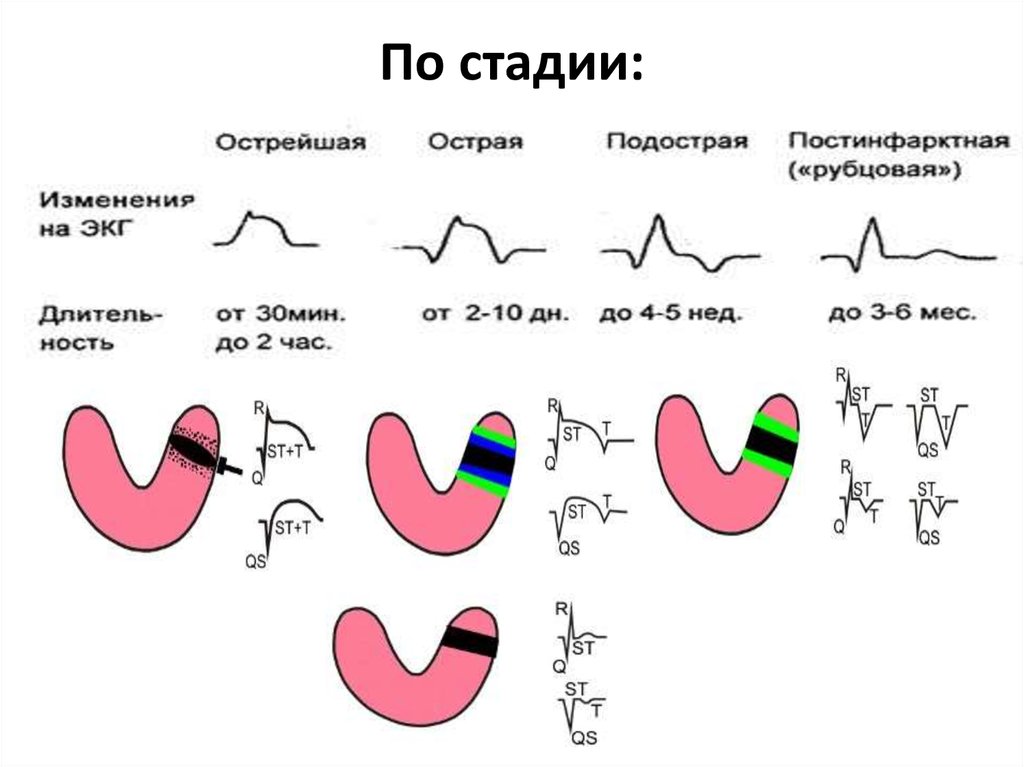 Стадии инфаркта миокарда. 2 Стадия инфаркта миокарда ЭКГ. Инфаркт миокарда ЭКГ сегмент St. Острейшая острая подострая стадии инфаркта миокарда. ЭКГ инфаркт миокарда без подъема St.