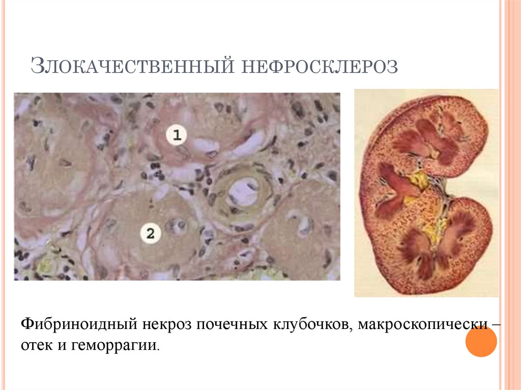 Артериолосклеротический нефросклероз микропрепарат рисунок