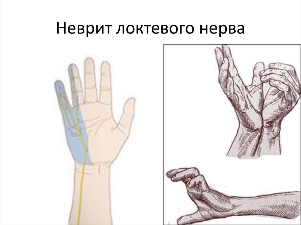 Невропатия нерва руки