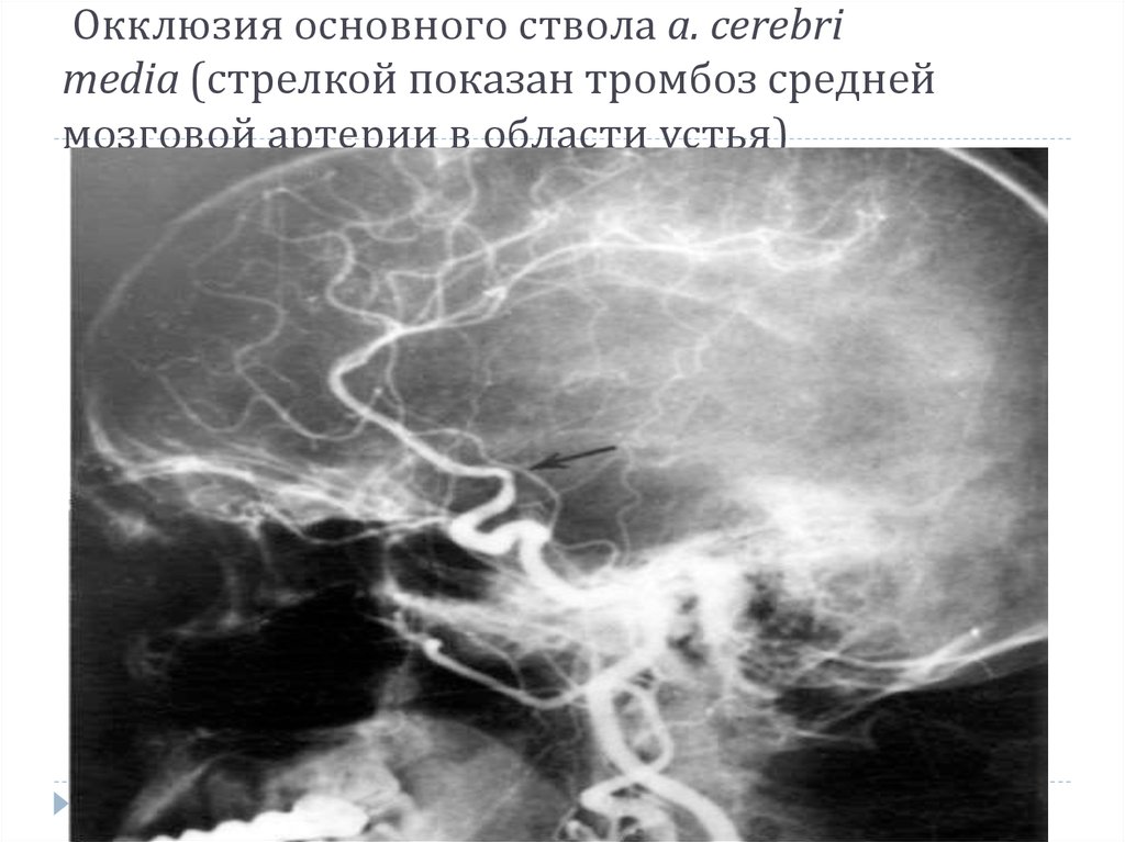  Окклюзия основного ствола a. cerebri media (стрелкой показан тромбоз средней мозговой артерии в области устья)