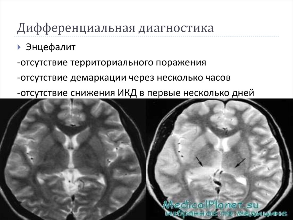 Отсутствие поражения. Территориальные инфаркты. Ламинарный инфаркт мозга. Демаркация мрт. Инфаркт мозга 18 баллов поражения.