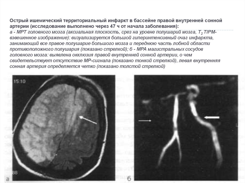 Инсульт в бассейне мозговой артерии. Бассейн правой внутренней сонной артерии инсульт клиника. Ишемический инсульт мрт. Инсульт в бассейне внутренней сонной артерии. Ишемический инсульт в бассейне левой внутренней сонной артерии.