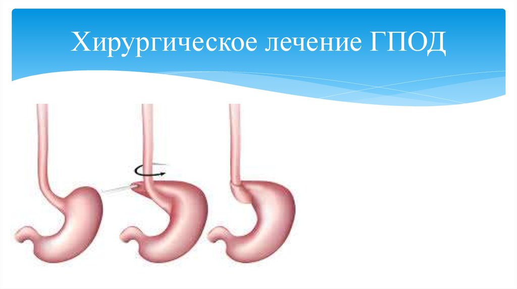 Схема лечения грыжи пищеводного отверстия диафрагмы