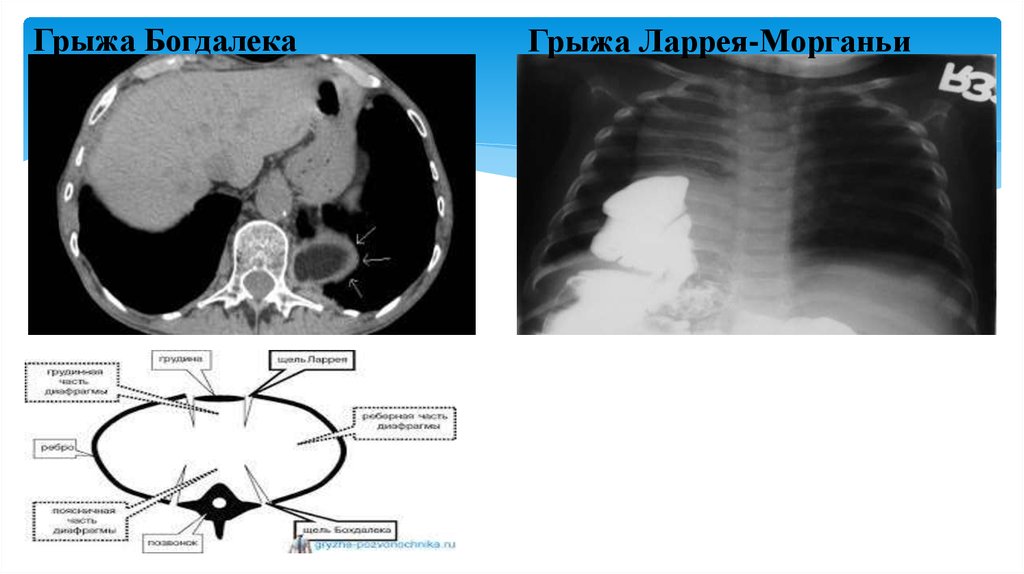 Грыжа бохдалека. Грыжи Богдалека, Морганьи-Ларрея.. Диафрагмальная грыжа Ларрея-Морганьи. Грыжи диафрагмы Ларрея.