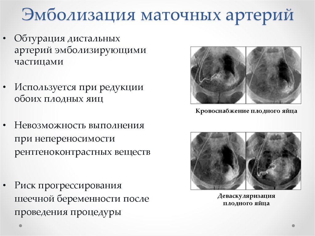 Эмболизация маточных артерий. Эмболизации маточных артерий. Эмболизация маточных артерий при шеечной беременности. Эмболизации маточных артерий (Эма)..