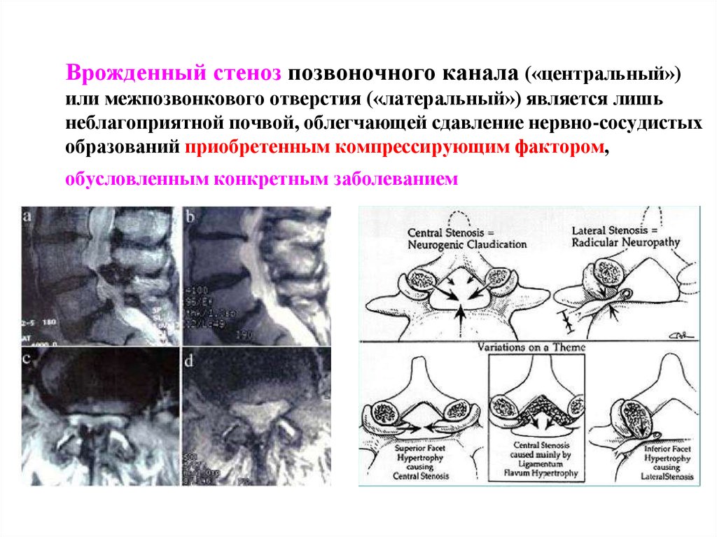 Стеноз позвоночного. Межфасеточный фронтальный стеноз позвоночного канала. Стеноз позвоночного канала классификация. Относительный Сагиттальный стеноз позвоночного канала с5-с7. Сужение корешковых каналов поясничного отдела позвоночника.