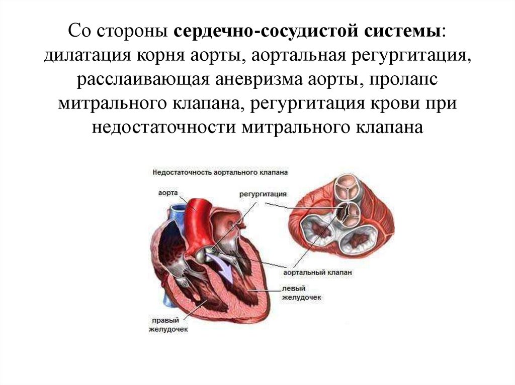 Сердечная недостаточность митрального клапана. Аневризма митрального клапана у взрослого. Расслаивающая аневризма аорты аортальная недостаточность. Недостаточность клапана аорты.