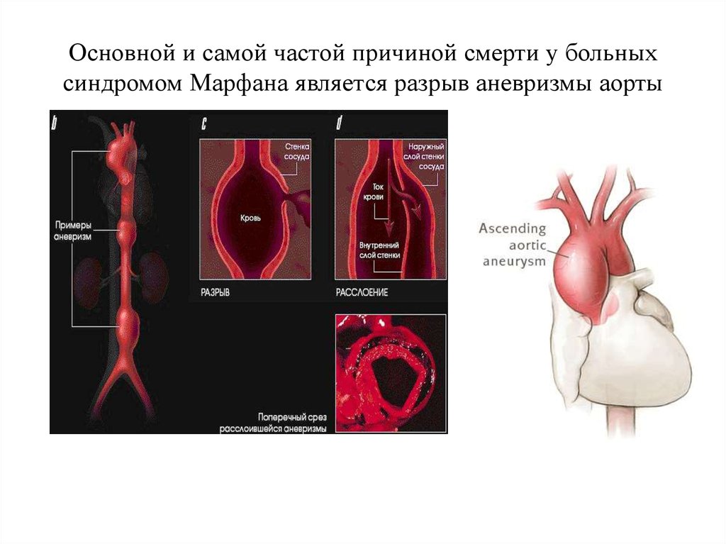 Аневризмы аорты презентация