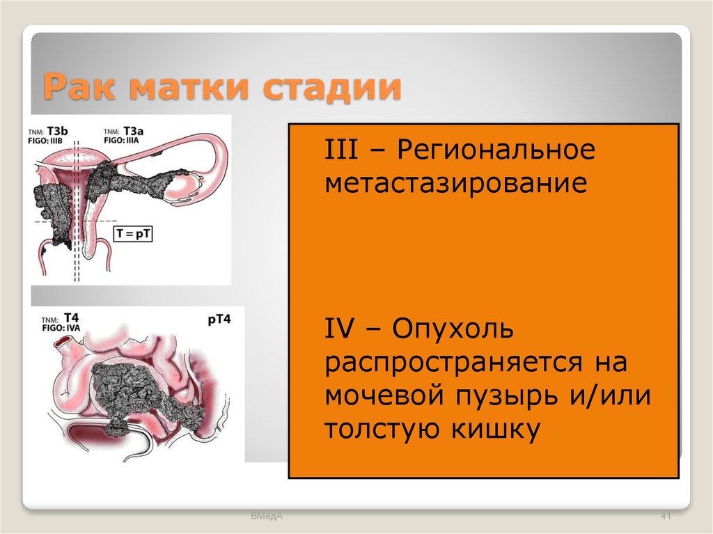 Рак третьей. Опухоли тела матки стадии. Стадии онкологии матки. Онкология эндометрия матки.